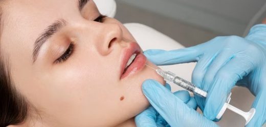Lip Filler